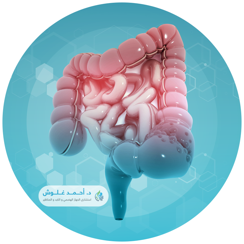 علاج التهاب القولون التقرحي