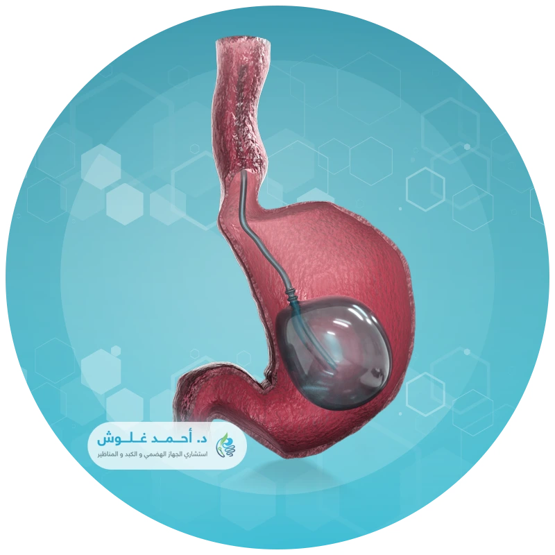 بالون المعدة