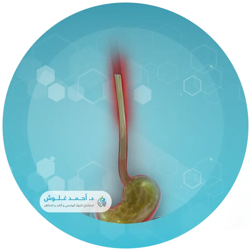 تقنیة آرما ARMA لعلاج ارتجاع المريء