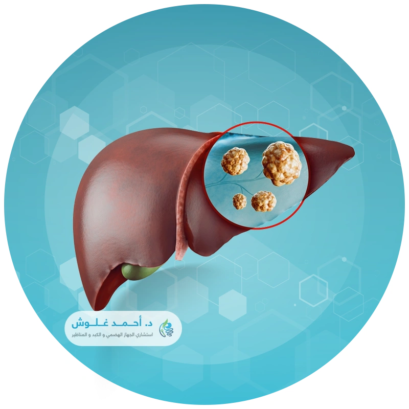 علاج دهون الكبد